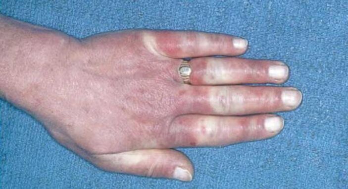 Κλινική εικόνα του συνδρόμου Raynaud - αγγειόσπασμος, υπεραιμία, οίδημα
