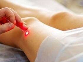 Θεραπεία της αρθρίσεως της άρθρωσης του γόνατος με λέιζερ